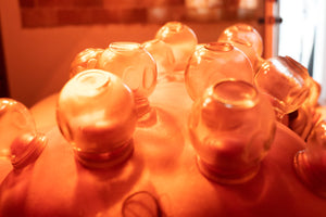 Acupuncture and Cupping